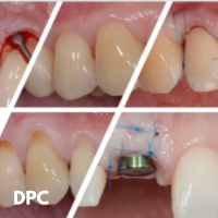Chirurgie plastique parodontale et péri-implantaire DPC